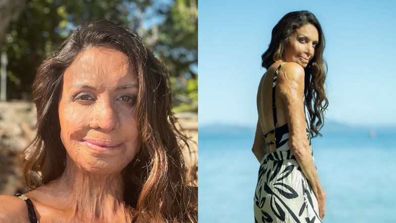 Turia Pitt cudem wyszła cało z pożaru