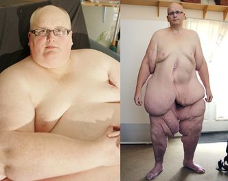 NAJGRUBSZY człowiek świata SCHUDŁ 330 KILO! (FOTO)