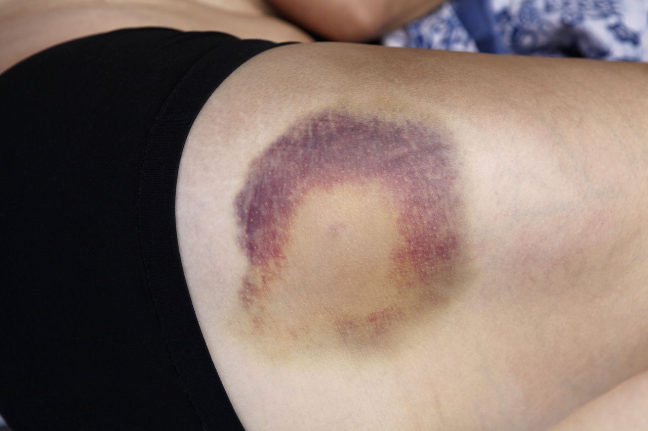 What can bruises on the body indicate?