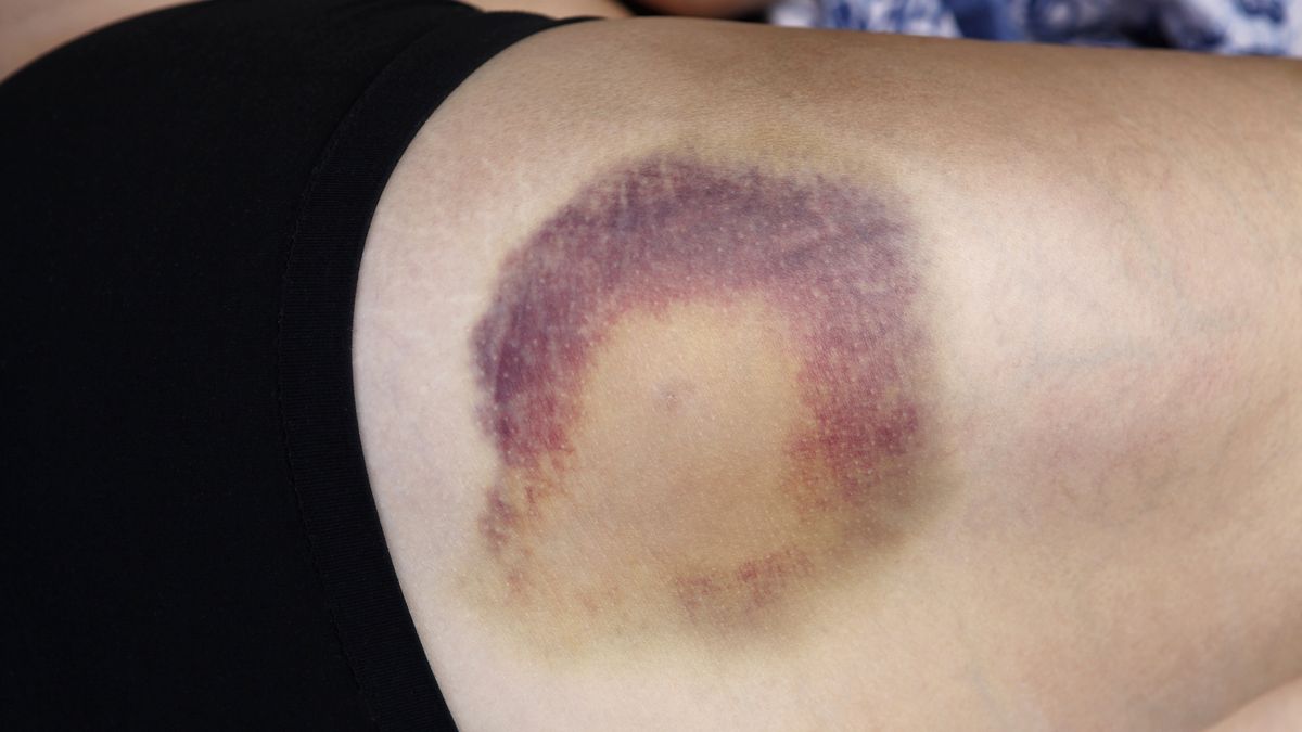 O czym mogą świadczyć siniaki na ciele?