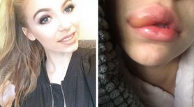 Chciała upodobnić się do Kylie Jenner. Kupiła produkt, który wywołał silną reakcję alergiczną