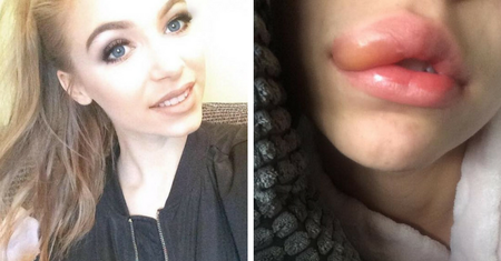 Chciała upodobnić się do Kylie Jenner. Kupiła produkt, który wywołał silną reakcję alergiczną