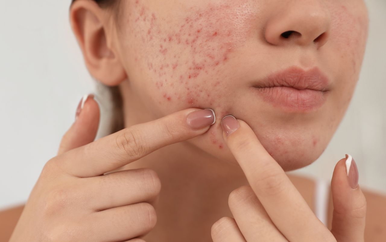 Specialists regularly warn against squeezing pimples.