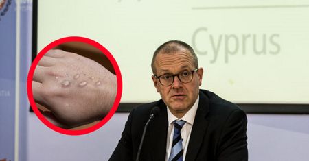Małpia ospa budzi zaniepokojenie. WHO wydało nowy komunikat