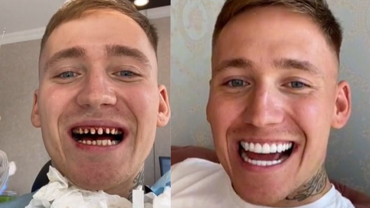 Zrobił sobie "tureckie zęby"