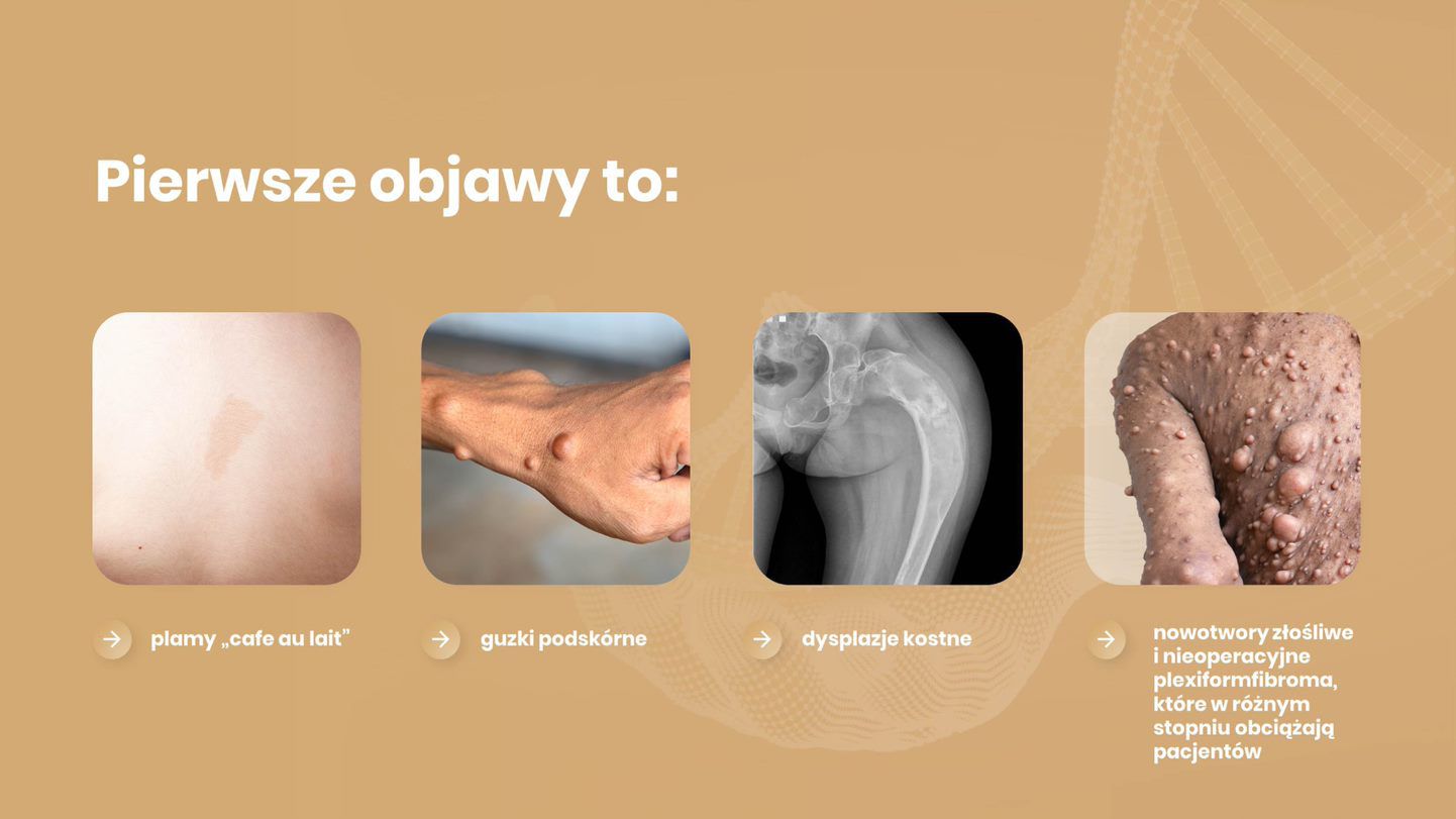 Tak objawia się choroba