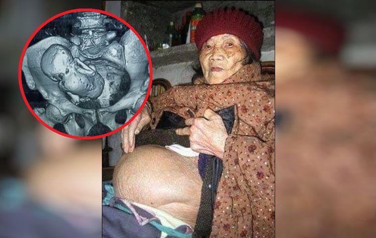Była w ciąży przez 61 lat. Urodziła "kamienne dziecko"