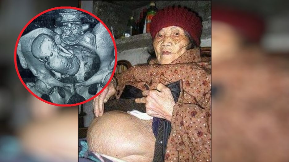 Była w ciąży przez 61 lat. Urodziła "kamienne dziecko"