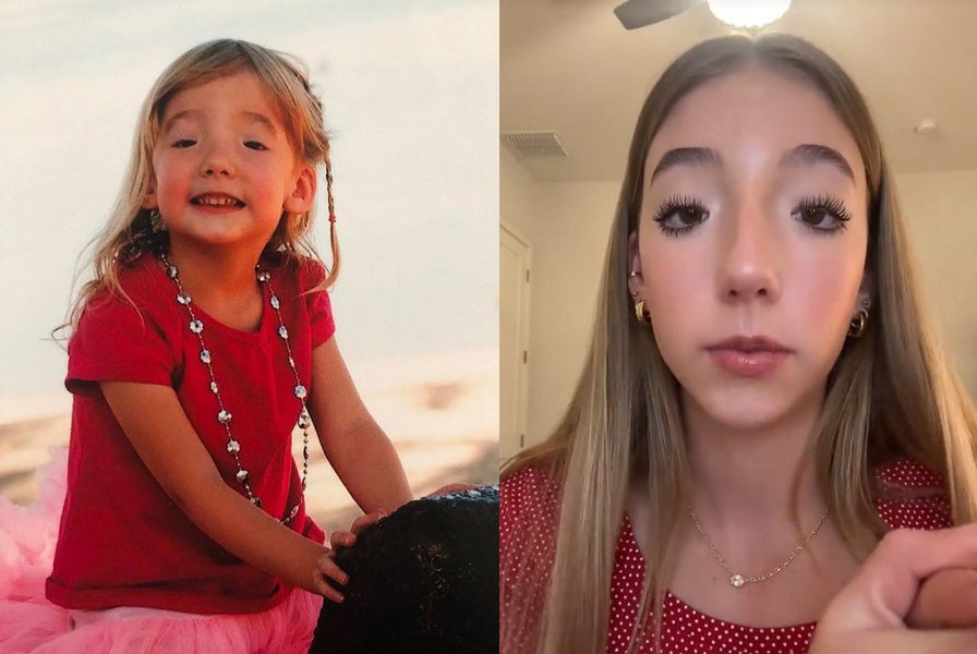 Do mrugania służą jej brwi. 19-latka opowiedziała o rzadkiej wadzie