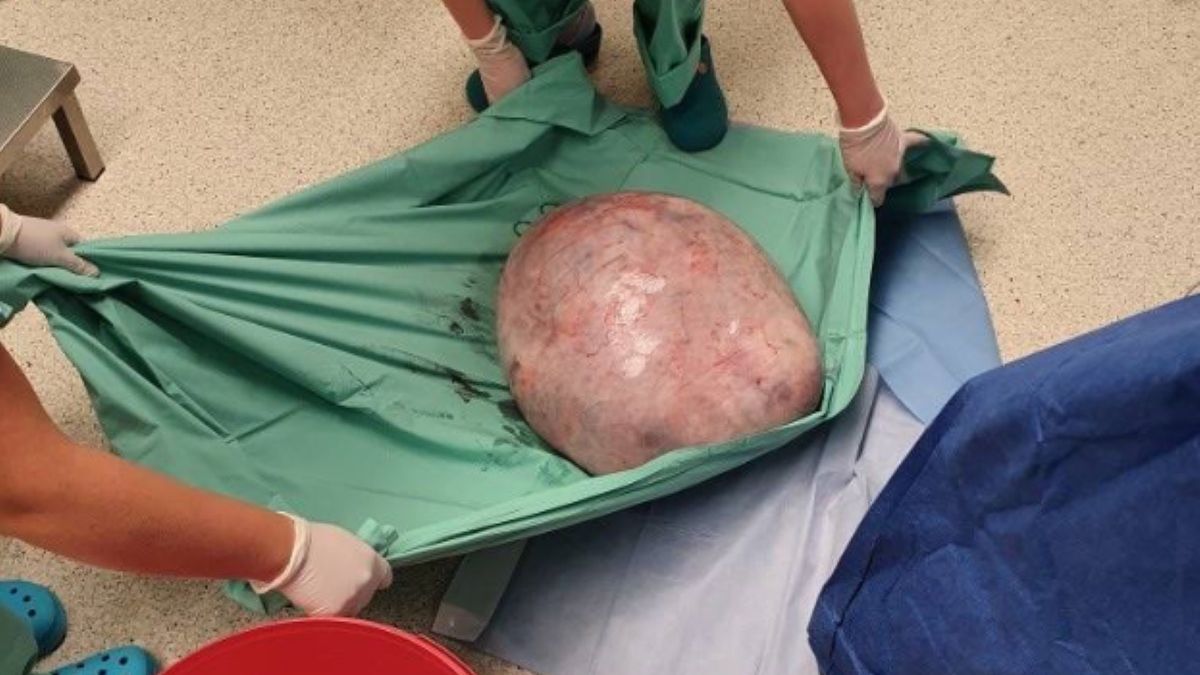 Guz jajnika ważył aż 30 kilogramów