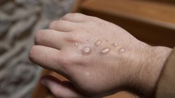 Małpia ospa. W Polsce będzie obowiązek kwarantanny i hospitalizacji