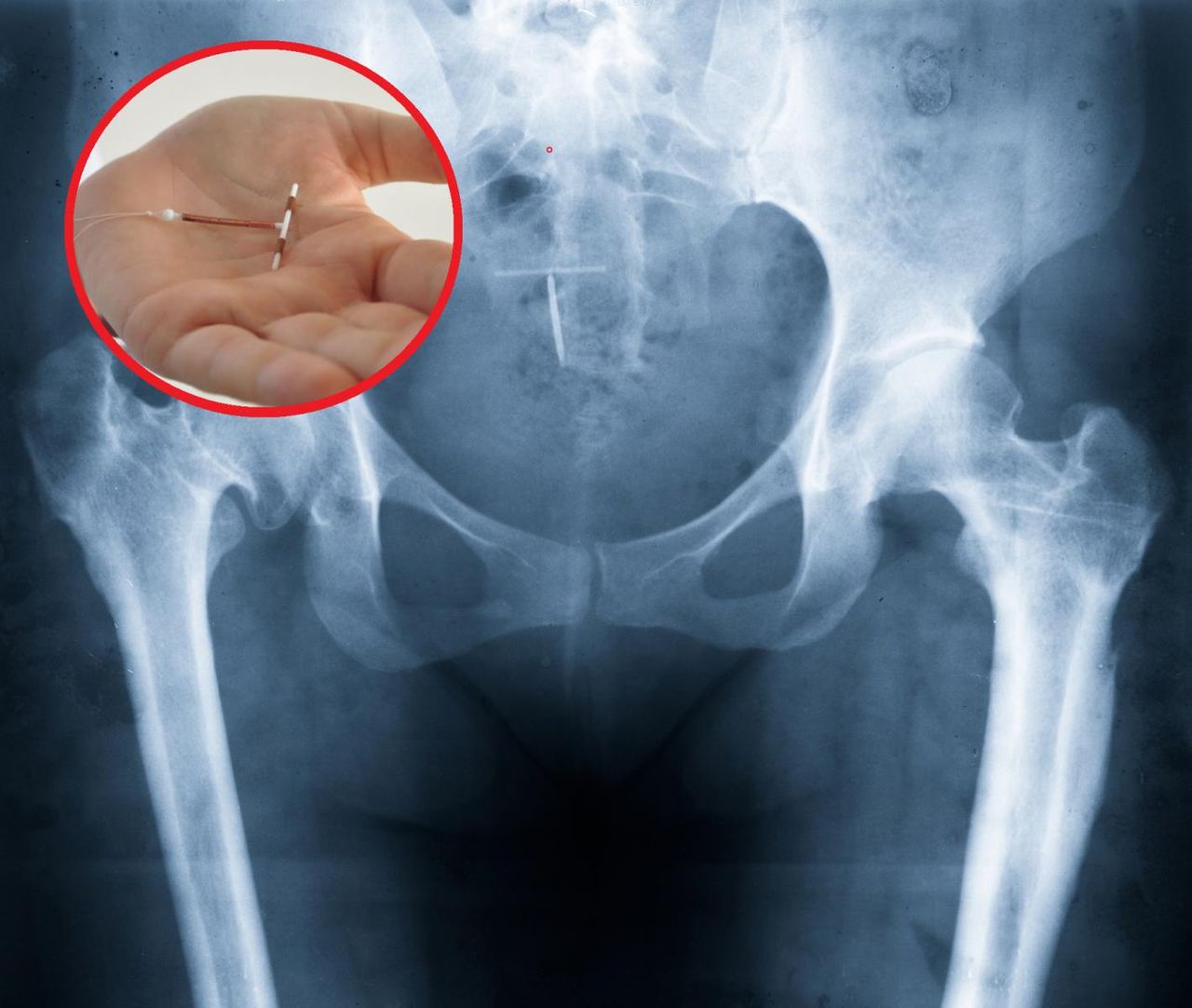 Niebezpieczny trend na TikToku. Kobiety samodzielnie usuwają wkładki domaciczne. Lekarze apelują o rozsądek: Nie warto ryzykować