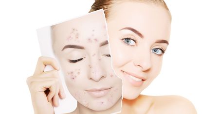 Acne-derm - charakterystyka, wskazania, stosowanie, bezpieczeństwo