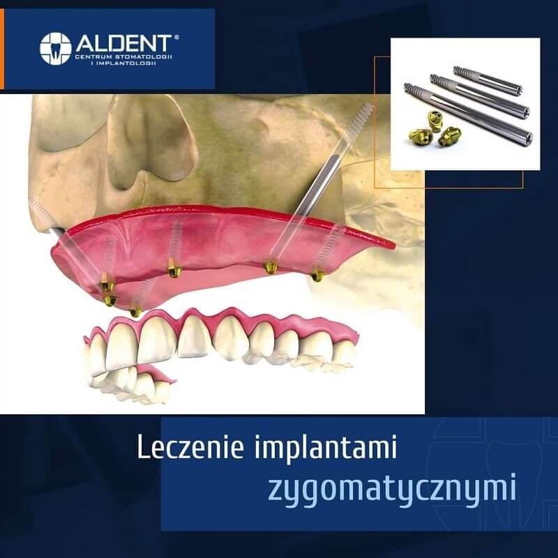 Leczenie implantami zygomatycznymi