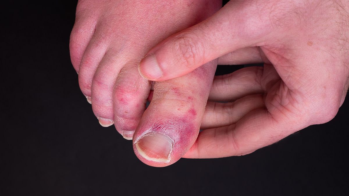 Po przejściu COVID mogą się pojawić plamy i zaczerwienienia na stopach. Część pacjentów narzeka na swędzenie i łuszczenie skóry