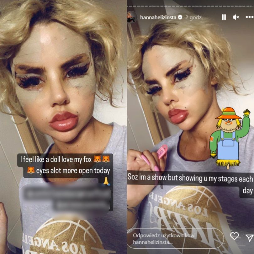 Uczestniczka brytyjskiego "Love Island" chwali się efektami operacji w tureckiej klinice
