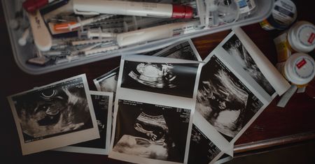 AI na tropie plemników. Szansa na przełom w leczeniu męskiej niepłodności