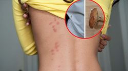 Taka grudka to znak, że ugryzł cię "latający kleszcz"
