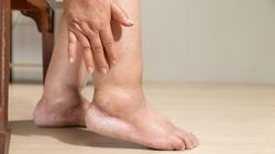 Może sygnalizować raka trzustki. Przyjrzyj się dłoniom i stopom 