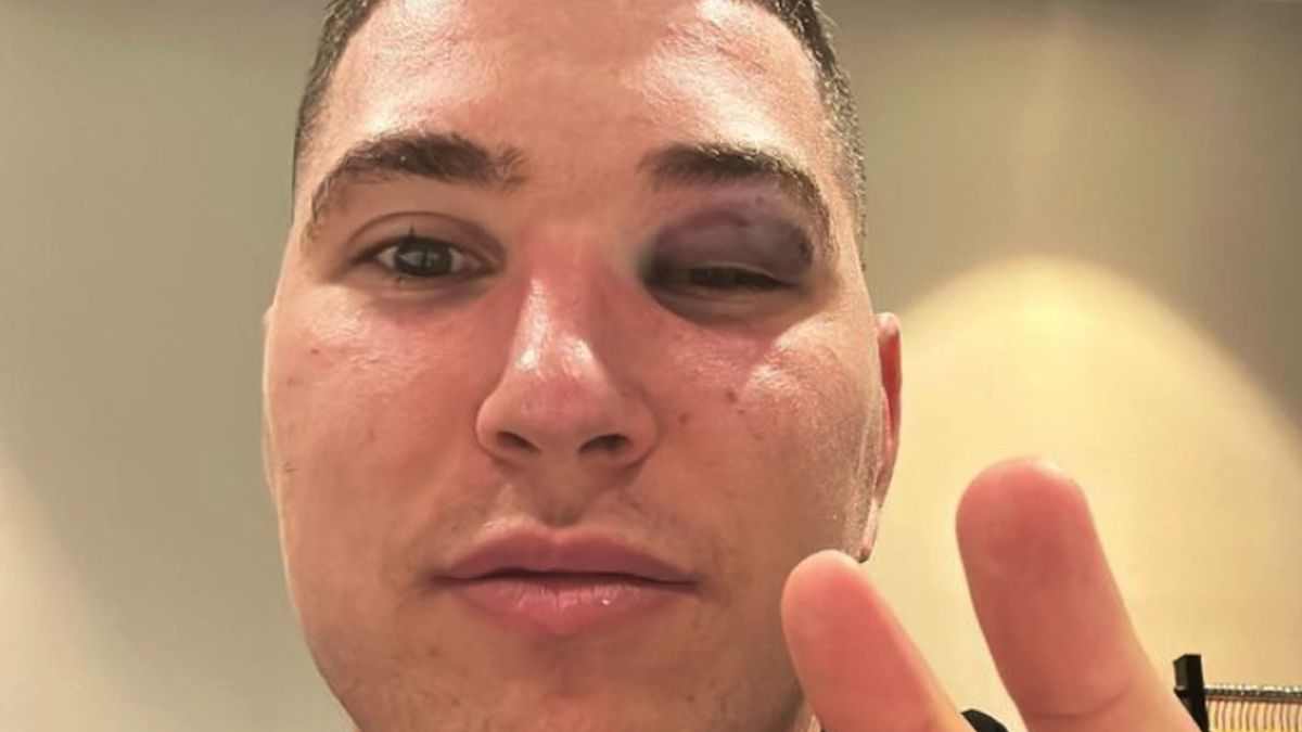 Joel Parra doznał bolesnej kontuzji