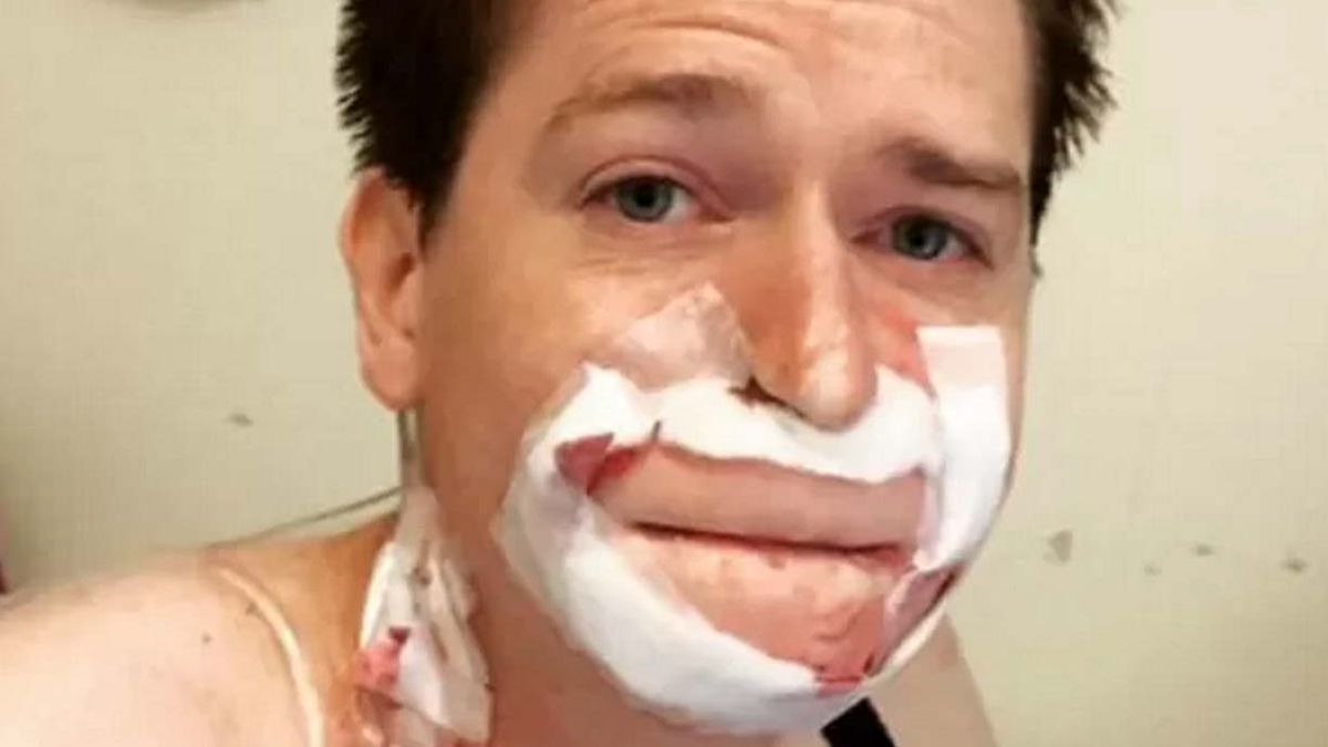 Alex Lewis był zakażony paciorkowcem z grupy A