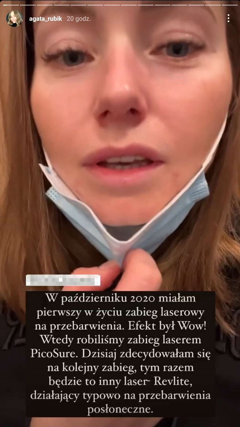 Agata Rubik relacjonuje zabieg laserowy i pokazuje opuchliznę 