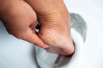 Ratunek na pękające pięty. W aptece kupisz za grosze