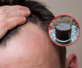 Popularny napój zwiększa ryzyko wypadania włosów. Zwłaszcza u mężczyn