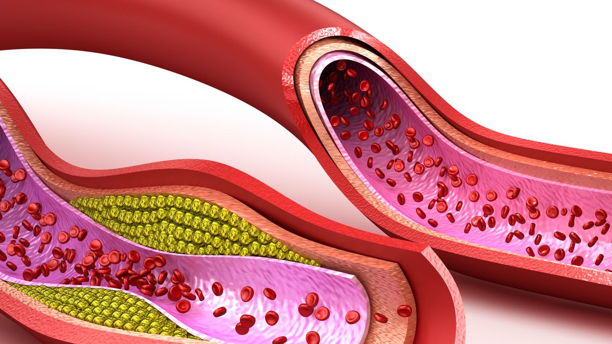 Modyfikując dietę można pozbyć się złogów cholesterolu