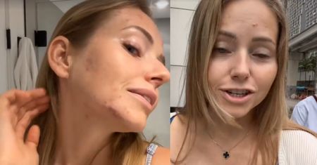 Agata Rubik zmaga się z trądzikiem. Pokazała, jak teraz wygląda jej cera. "Mężowi nadal się podobam?" (FOTO)