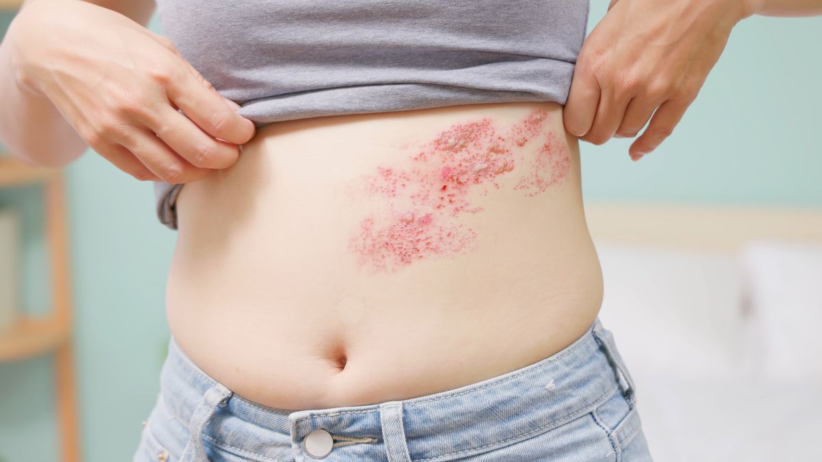 Bolesna wysypka i miesiące cierpienia