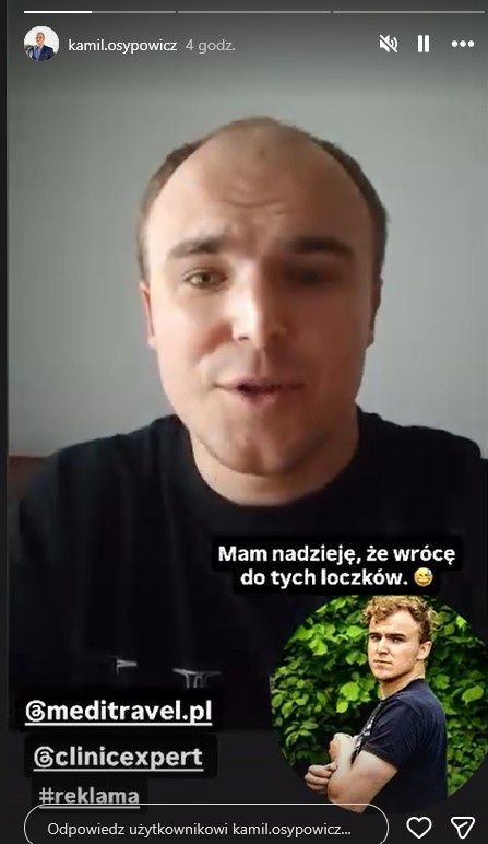 Kamil Osypowicz o przeszczepie włosów