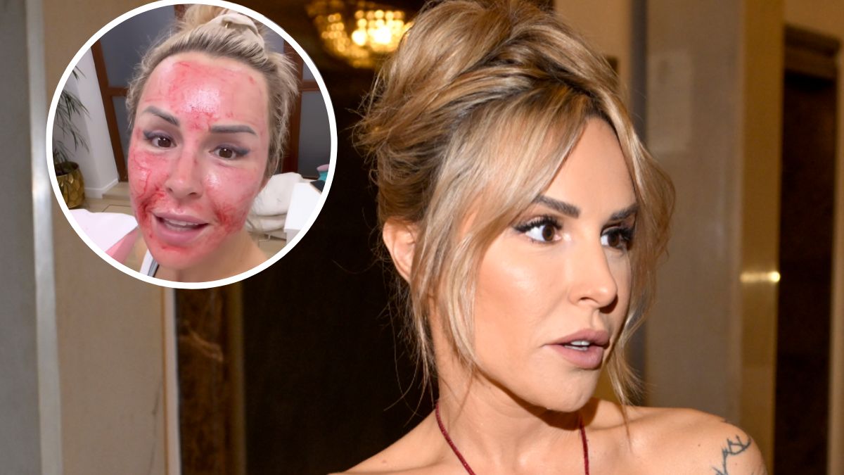 Blanka Lipińska pochwaliła się zakrwawioną twarzą