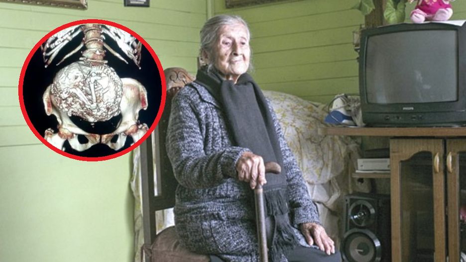 Lekarze nie mogli uwierzyć. 91-latka miała w brzuchu 60-letnie "dziecko"