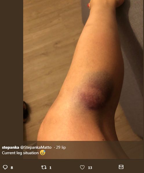 Na skórze Stephanie przy najdrobniejszym urazie pojawiają się siniaki i krwiaki