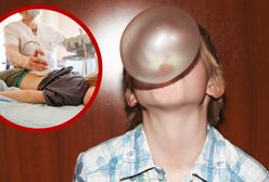 USA. Pięciolatek przeżył koszmar. Gumy do żucia zablokowały jego żołądek