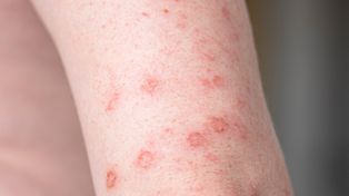 Wiadomo, kim była pierwsza osoba zakażona kiłą. W szczątkach odkryto ślad krętka