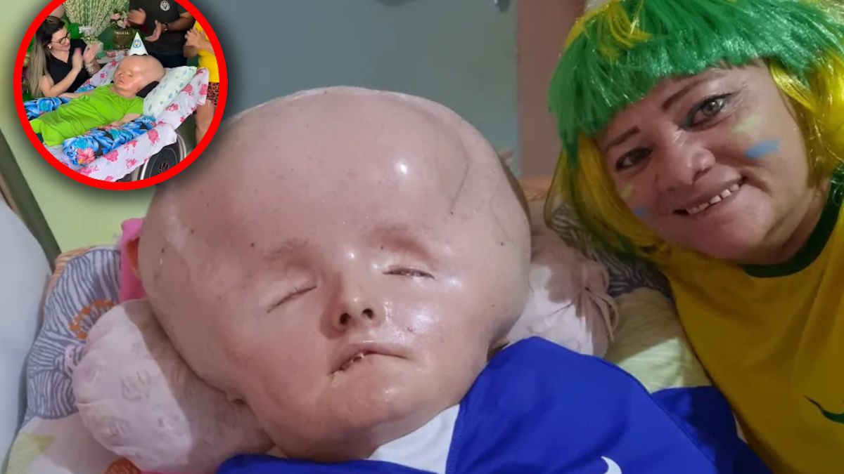 Kobieta żyje już 4 dekadę z poważną wrodzoną chorobą