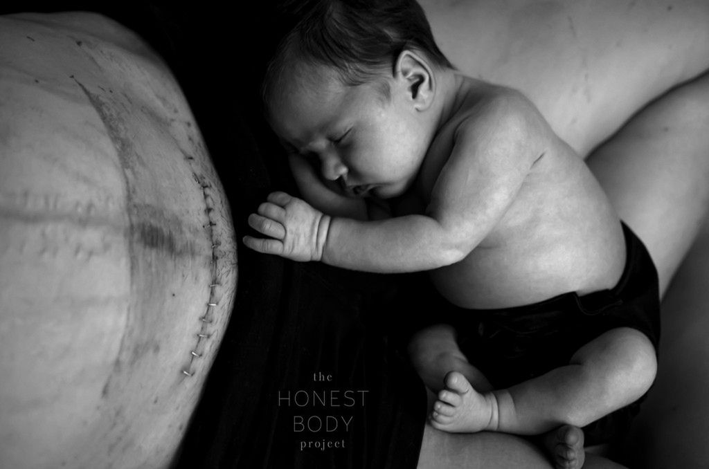 Jacqueline walczy z ciężką endometriozą