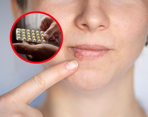 Znak, że brakuje ci witaminy B2. Zwróć uwagę na usta, skórę