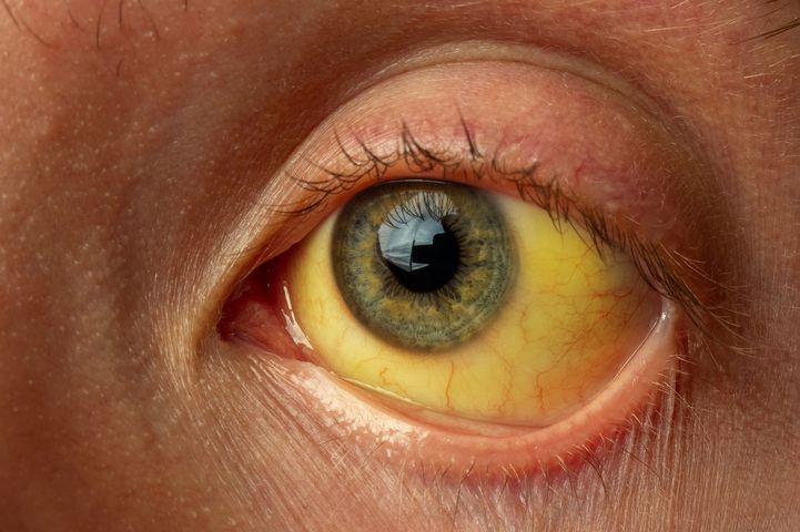Żółtaczka nie jest chorobą, a jedynie jej objawem polegającym na zażółceniu skóry, białek oczu i błon śluzowych