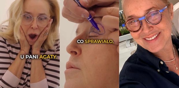Agata Młynarska pokazała się po BLEFAROPLASTYCE POWIEK w barterze. "Nie chodziło TYLKO O ESTETYKĘ" (FOTO)