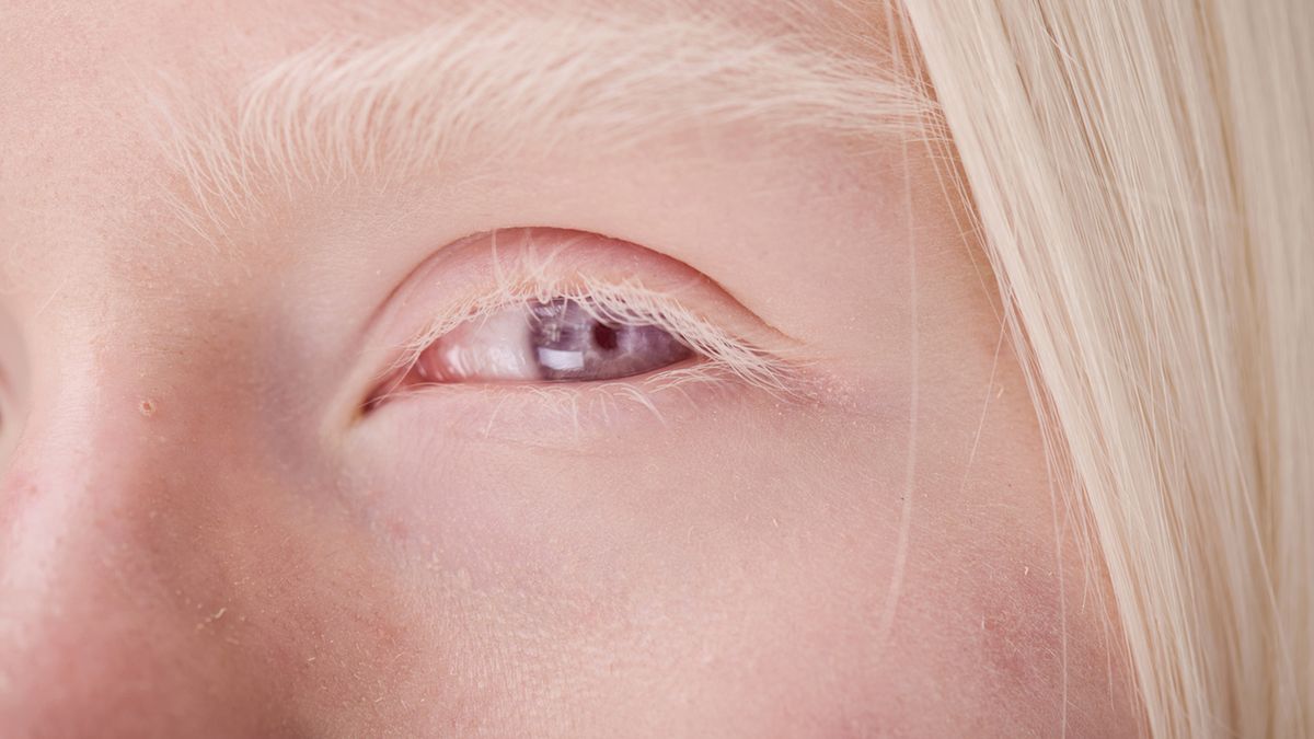 Albinizm oczny to choroba uwarunkowana genetycznie.