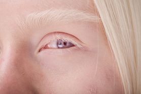 Albinizm oczny – objawy, dziedziczenie i leczenie