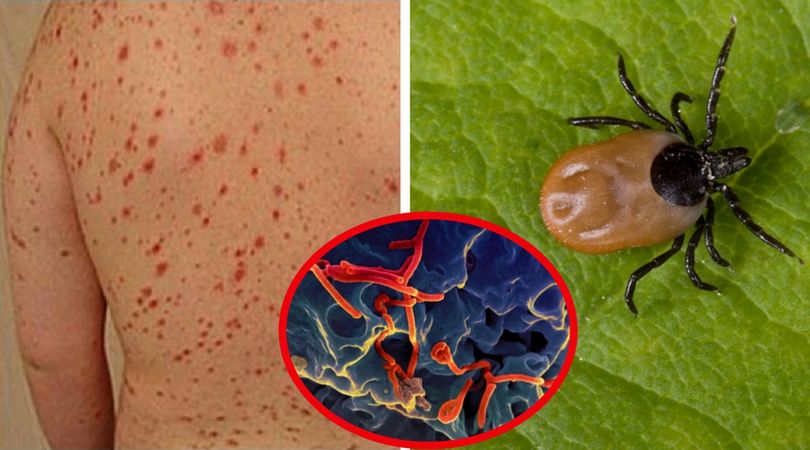 Odkryto nowy wirus przenoszony przez kleszcze. Zabija w kilka dni i nie ma na niego leku