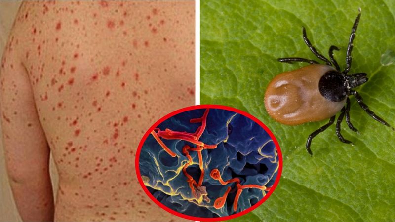 Ostra wysypka jako objaw wirusa Bourbon oraz widok rozwijającego się wirusa, przenoszonego przez kleszcza