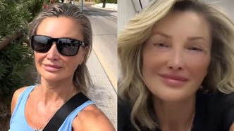 Zafundowała sobie nową twarz w tureckiej klinice. Trudno uwierzyć, ILE MA LAT. Zgadniecie?