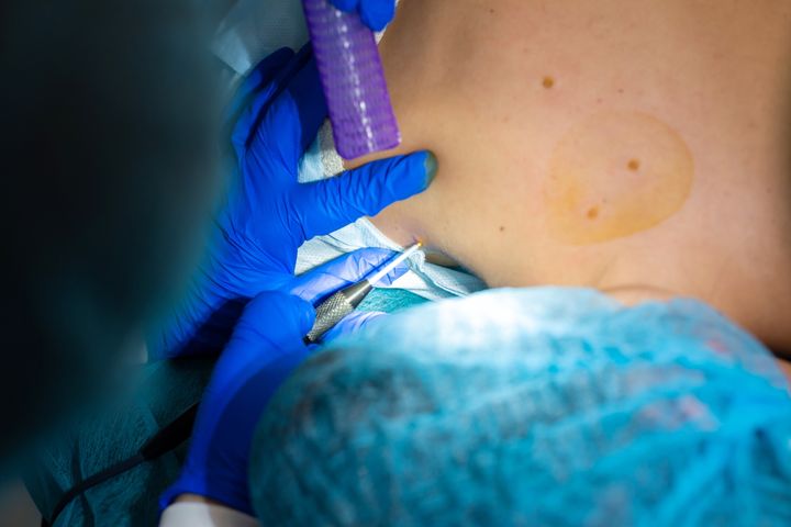 Biopsja  skóry przeprowadzana jest z wykorzystaniem sterylnych narzędzi