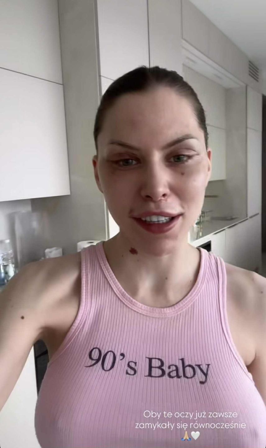 Julia von Stein pokazała zliftingowaną twarz 13 dni po operacji