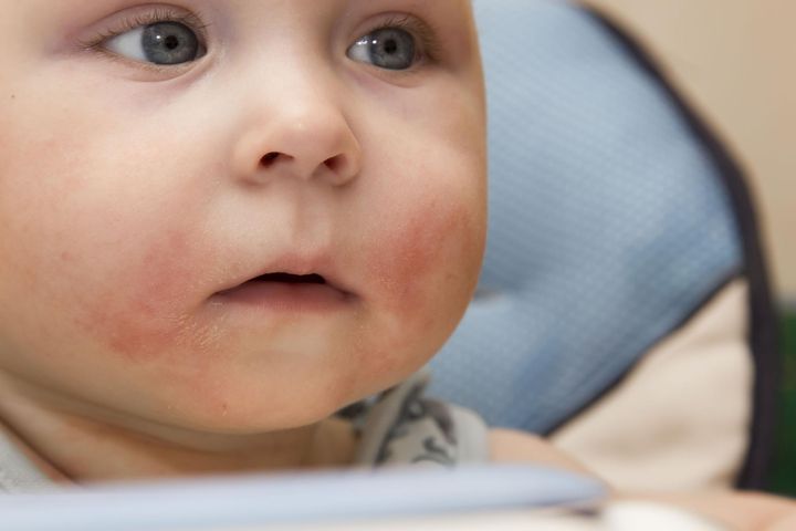 Alergia na gluten u niemowląt